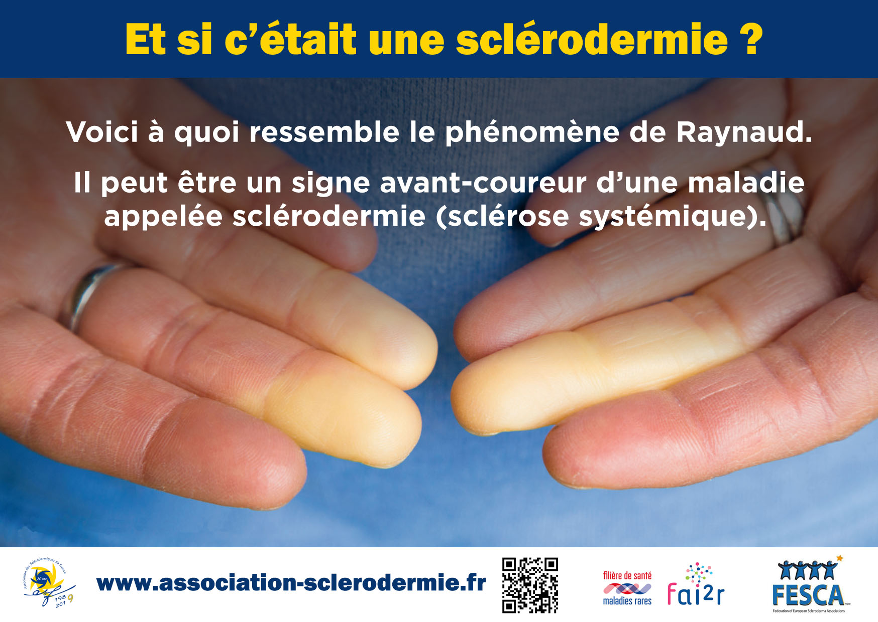 Le syndrome de Raynaud - ASF